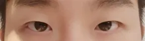 남자눈성형 10일~ 후기(눈매교정(비절개), 앞트임)