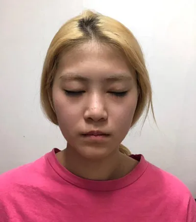 제이준성형외과에서 수술한 지 3달 됐어요!!