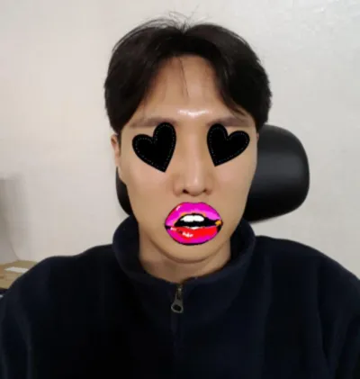 내시경이마거상(엔도타인), 코재수술(콧대,코끝), 휜코교정, 비공내리기