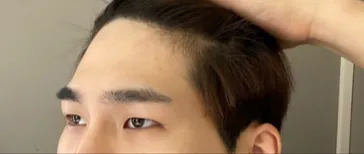 눈매교정이랑 이마거상 받은 '5개월 경과 후기입니다!