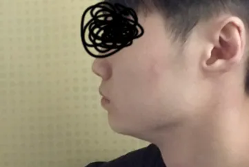 사각턱, 광대축소, 피질절골, 턱 보톡스