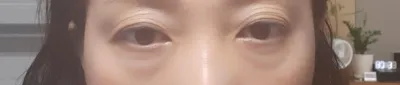 하안검수술