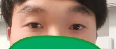 부분절개 눈매교정, 뒷트임 수술을 받았습니다.