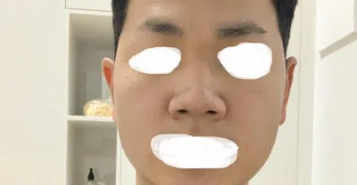 안녕하세요 코수술한지 1주일차에요