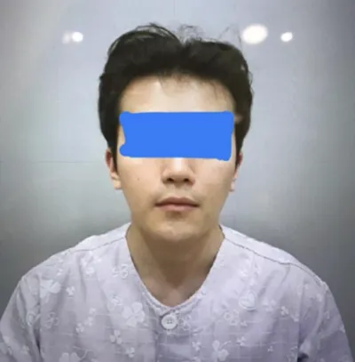 사각턱, 광대축소, 앞턱, 피질절골, 비너스레이저, 윤곽주사