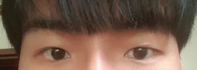 부분절개 눈매교정 재수술
