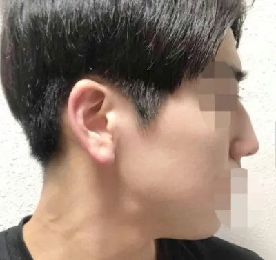 콧대, 코끝, 매부리, 코뼈축소, 복코교정