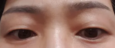 쌍꺼풀(절개)