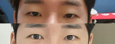 눈매교정(부분절개), 앞트임