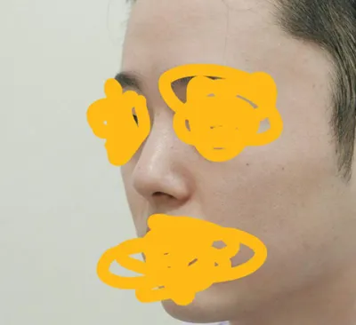 몇 년전에 한 코가 마음에 들지 않아 제이준에서 코재수술받았어요.