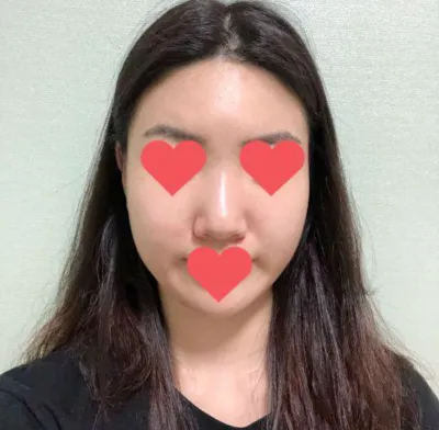 코수술 2년차 후기