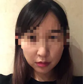 제이준에서 안면거상 받았고 이제 3주차 접어들었어요.