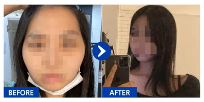 [바비톡] 안면윤곽 / 1개월차/ 닉네임: 다라뮈