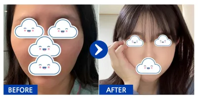 [바비톡] 안면윤곽 / 3개월차/ 닉네임: orini