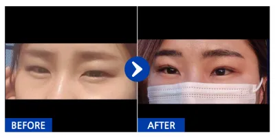 [바비톡] 쌍꺼풀/ 4개월차 / 닉네임 : 발랄걸