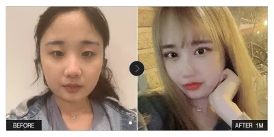 [바비톡 후기]  눈성형, 윤곽성형 한 달차 / 닉네임 : 지와링