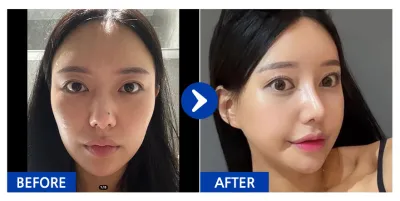 [강남언니 후기] 윤곽3종(광대,턱끝,사각턱), 코성형 / 3주차 / 닉네임:박땐땐