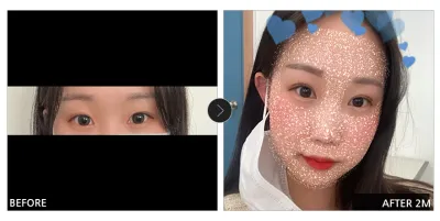 [강남언니 후기] 눈성형 한 달차 / 닉네임 : 꽃신신자