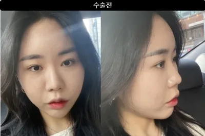 [강남언니 후기] 코성형 1개월차 / 닉네임 : 드르르륵드르륵