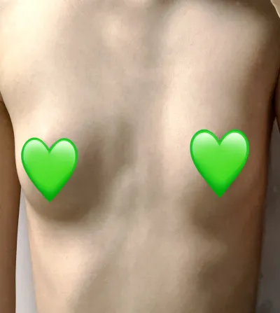 [가슴] 모기박멸 - 가슴