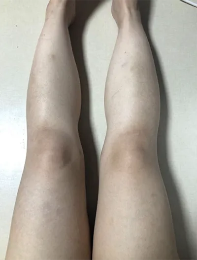 [지방흡입] zz0808 - 지방흡입