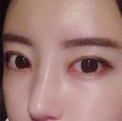 [코] tatun12 - 코, 눈, 지방이식