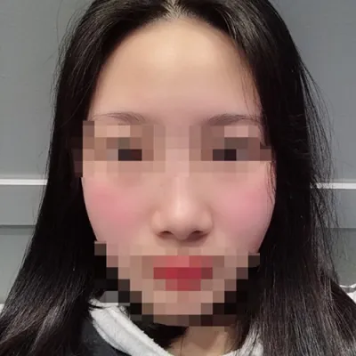 [쁘띠] 효콩2 - 필러, 보톡스