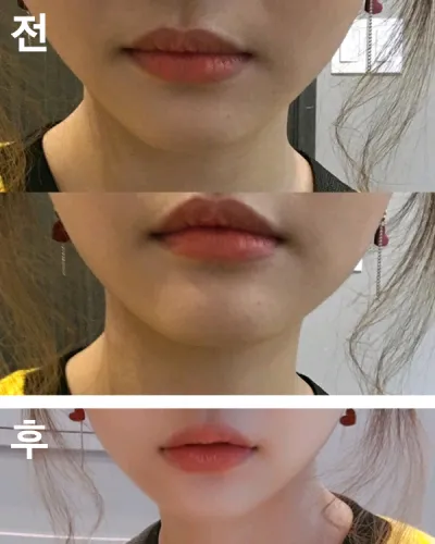[쁘띠] 데굴쓰 - 입술필러