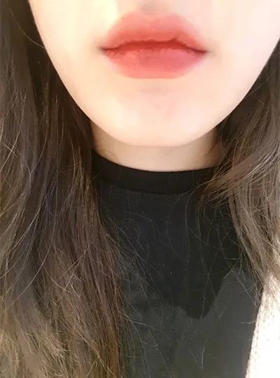 [쁘띠] 지똘이 - 입술필러,보톡스