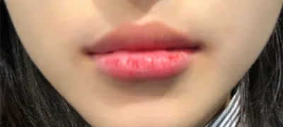 [쁘띠] 이이ddd - 입술필러