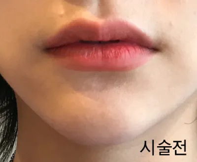 [쁘띠] 랄랄링동 - 입술필러