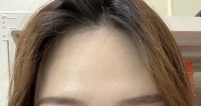 [안티에이징] 나에요~~ - 이마지방이식