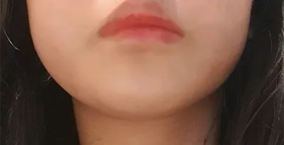 [피부] 긔단 - 레이저리프팅