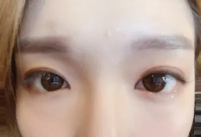 [눈] 성형뚜둘 - 눈