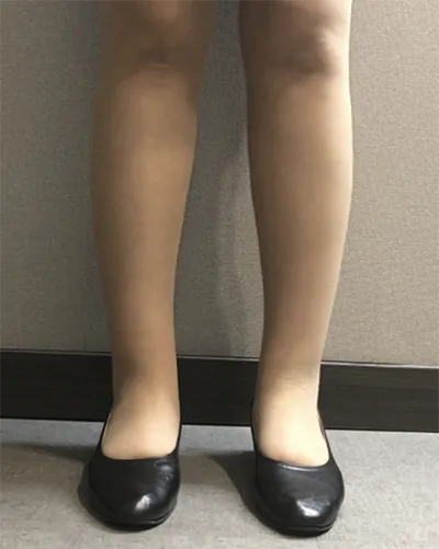 [지방흡입] 별처럼날아라 - 종아리