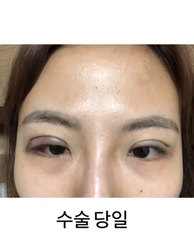 [눈] 스리8536 - 눈매교정