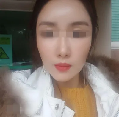 [안티에이징] 빈빈집 - 얼굴지방이식