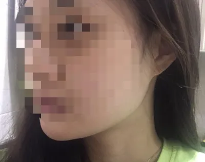 [쁘띠] 니나낭이잉 - 지방분해주사,리프팅