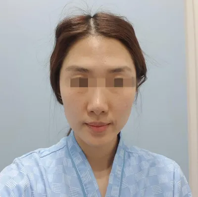 [쁘띠] 빈빈집 - 풀페이스 지방이식