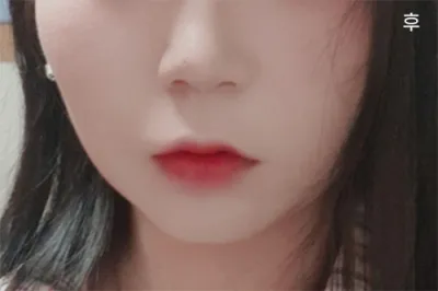 [안티에이징] alss12 - 얼굴 지방흡입