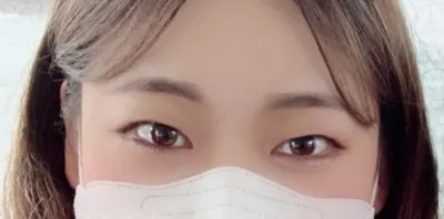 [눈] 다롬이 - 쌍꺼풀(절개),  눈매교정