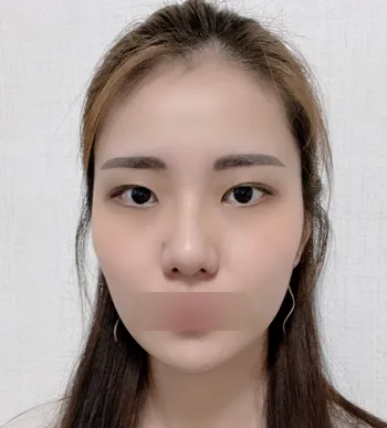 [안면윤곽] 감쟈함다 - 윤곽