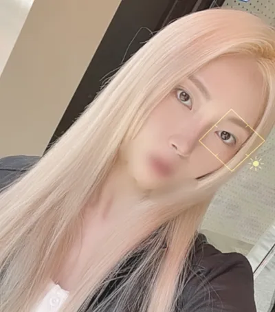 [코] 엘리샤 - 코,눈밑지방재배치