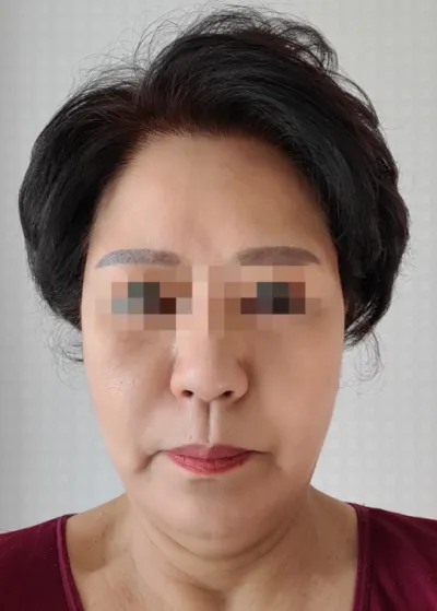 [안티에이징] 아카시아 - 안면거상술