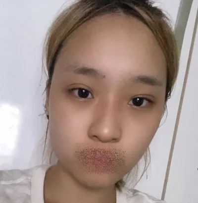 [안면윤곽] 이클립스 - 눈,코,윤곽