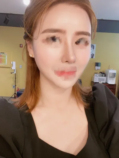 [안티에이징] 질문받아용 - 풀페이스 지방이식,코