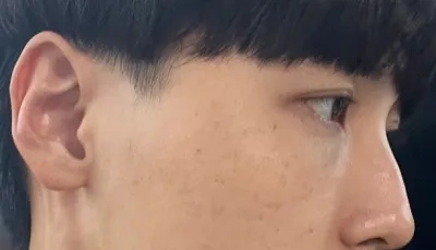 [안면윤곽] 두달차임 - 눈,코,윤곽