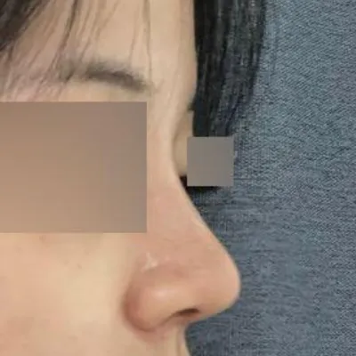 위버스 성형외과 코수술 한달차