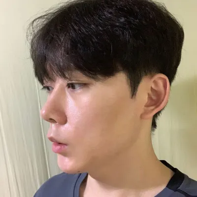 심정환 원장님께 코수술 한 지 2주 차 입니다