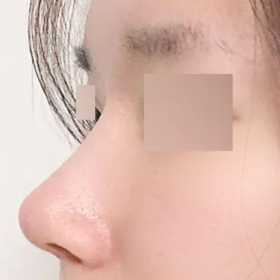 작고 눌린 매부리코 수술 한 달차 후기